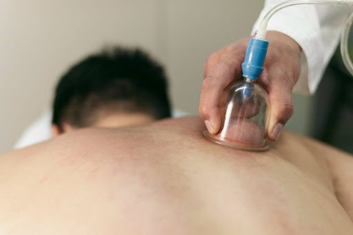 how-cupping-therapy-bellevue-connects-body-and-mind
